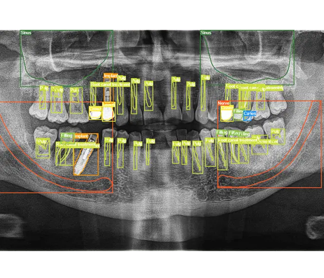 Dental Implants