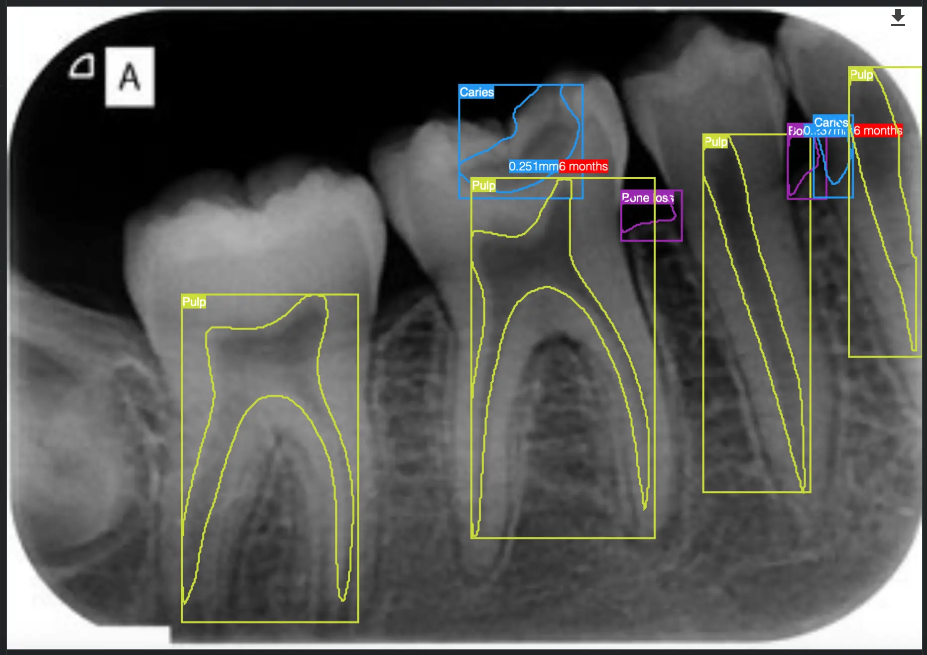 Detection of caries